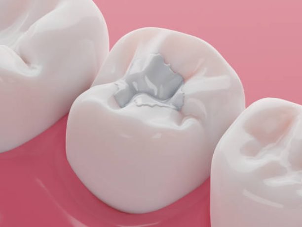 Teeth white composite filling, Decay and broken teeth treatment concept. 3D rendering.