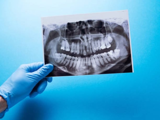 A dentist holding snapshot the patient's tooth and indicates the problem. Panoramic shot of the jaw on a blue isolated background.