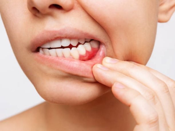 Gum inflammation. Cropped shot of a young woman showing red bleeding gums isolated on a white background. Close up. Dentistry, dental care