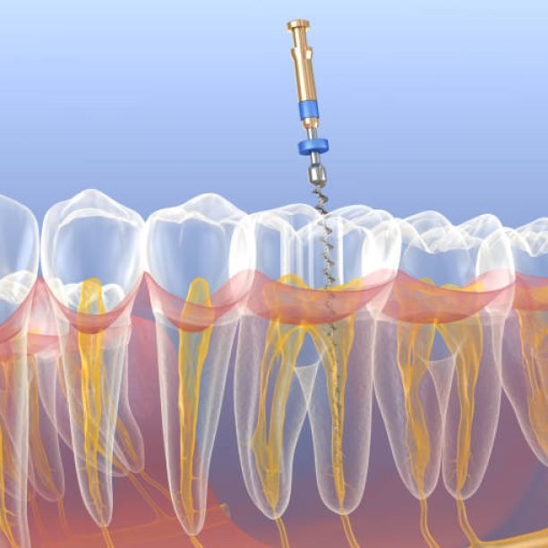 Endodontic root canal treatment process. Medically accurate tooth 3D illustration.