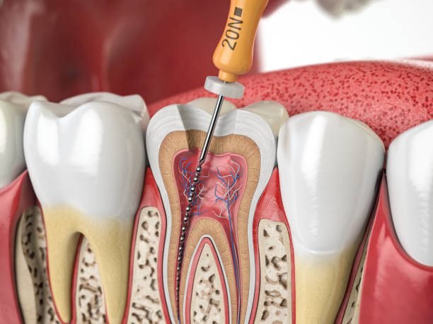 Cross section of human tooth with endodontic rotary file. 3d illustration