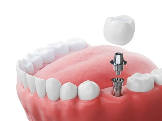 Dental implantation, teeth with implant screw, 3d illustration.