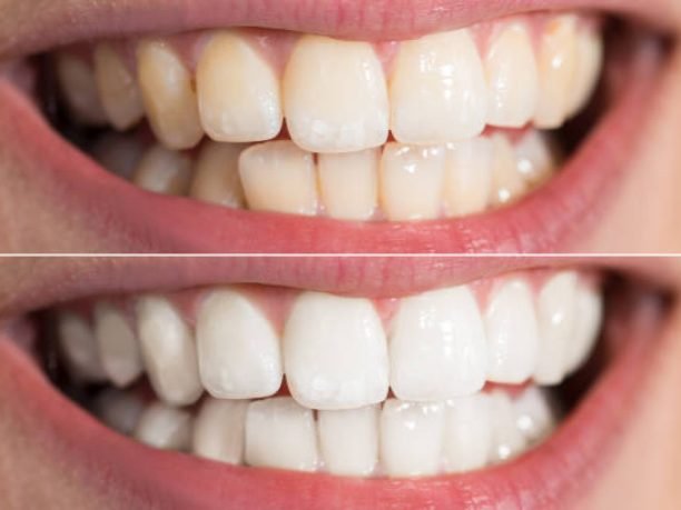 Close-up Detail Of Person Teeth Showing Before And After Whitening