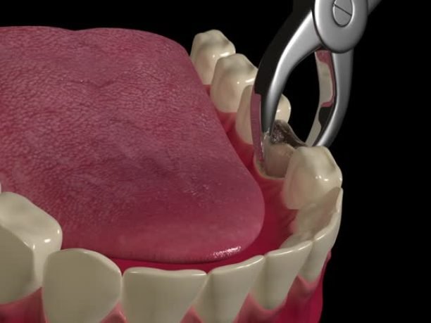 This video shows the Tooth extraction